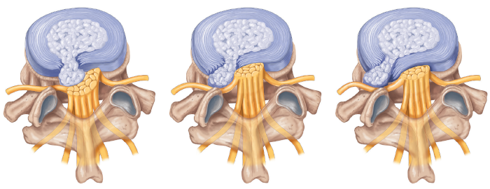 Lumbar Disc Herniation