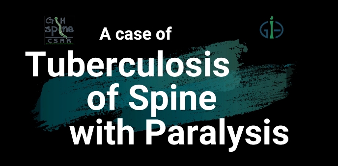 A Case of Tuberculosis of Spine With Paralysis
